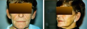 lifting πρόσωπο mini face lift